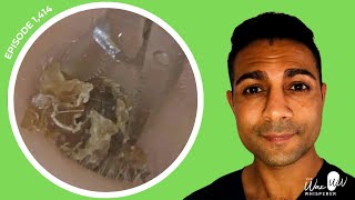 1414  Extreme Pruritus Dead Skin Keratin Removal  Read BSHAA Reply [upl. by Eelarual854]