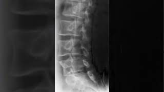 Lumbar Spine Oblique Radiology Tutorial [upl. by Etnwahs945]