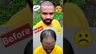 One week journey of Hair Transplant 😍😘❤️ 5M Views 🫶 Thank You Bhai hairtransplant D2LifeVlogging [upl. by Pietje]