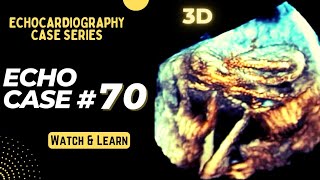 Echocardiography Case 70 Echo Spot Diagnosis Series  Cardiology [upl. by Aiyotal]