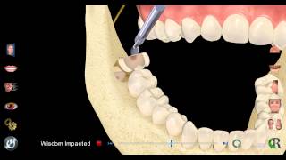 Impacted Wisdom Tooth Extraction [upl. by Rimisac]