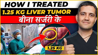 125 kg का liver tumor बिना सर्जरी के कैसे ठीक कर सकते है  No Major Scar  Dr Gaurav Gangwani IR [upl. by Lanni]