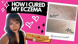 HOW I CURED MY ECZEMA Has not come back [upl. by Adirf452]