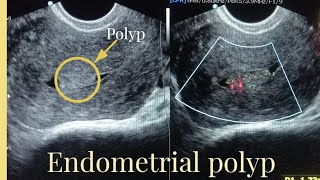 Ultrasound Report of endometrial polyp Sonography of Endometrial masspolyp [upl. by Etsyrk]