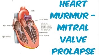 Mitral Valve Prolapse  Auscultation Sound [upl. by Iggie]