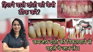 हिलने वाले दांतो का ईलाज।।treatment for teeth mobility splintingdentalpyorrhea periodontitis [upl. by Freida143]