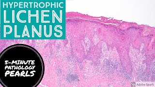 Hypertrophic Lichen Planus 5Minute Pathology Pearls [upl. by Eusassilem]