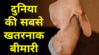 दुनिया की सबसे खतरनाक बीमारी  stone man disease [upl. by Aretse]