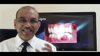 Pyogenic granuloma gums Patient teaching programme English [upl. by Binetta]