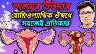 জরায়ুর টিউমারের জার্মানি হোমিওপ্যাথিক ঔষধ  Homeopathy medicine for uterine fibroid DrHarunRM [upl. by Nyleikcaj]