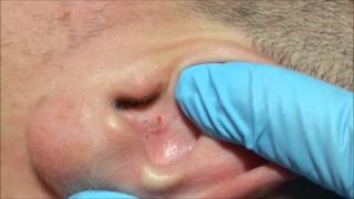 Ángels Acne Treatment Blackheads on the Ear [upl. by Nivak740]