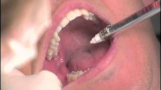 The Dental BoxInferior Alveolar Nerve Block [upl. by Stockwell915]