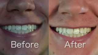 Crest 3D White Whitestrips 1 Hr Express Review and BeforeAfter [upl. by Waneta]