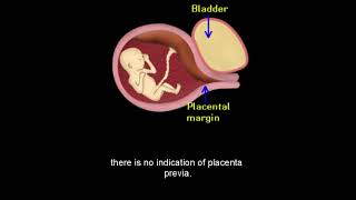 Ultrasound of the Placenta Level 1 [upl. by Lindsay]