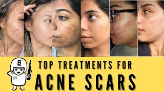 My Acne Scar Removal Journey RF Microneedling with PRP Treatments and Results [upl. by Silirama665]