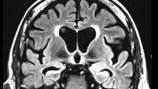 Mesial Temporal Sclerosis [upl. by Sutherland]