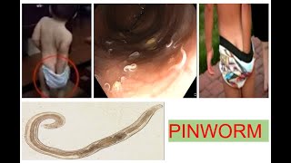 PINWORM FOR PAEDIATRICIANSendoscopy पेट colonoscopy worms [upl. by Sullivan]