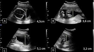 What is AFIAmniotic fluid index in pregnancy [upl. by Cortie]