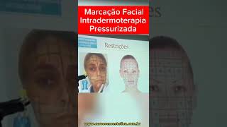 Marcação Facial para Intradermoterapia Pressurizada [upl. by Keeley]