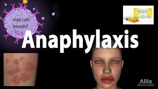 Anaphylaxis Animation [upl. by Caia]