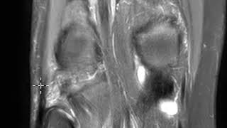 Popliteus tendon tear [upl. by Ollie]