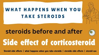 Steroid side effects  what happens when you take steroids  steroids side effects  steroid use [upl. by Steven]