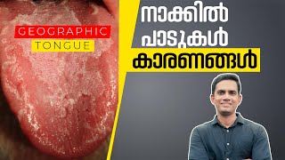 നാക്കിൽ പാടുകൾ വരുന്ന അസുഖം Geographic Tongue I കാരണങ്ങൾ [upl. by Oberg876]