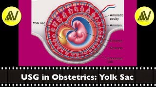 USG in Obstetrics Yolk sac [upl. by Florine]