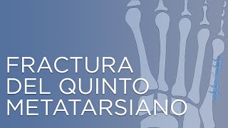 Fractura del quinto metatarsiano  IQTRA [upl. by Aluk895]