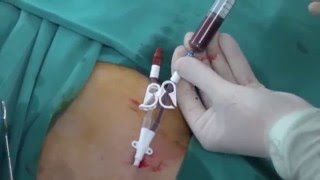 Permanent HD Cath insertion [upl. by Ihcur]