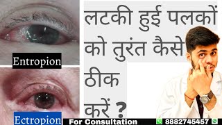 What is entropion and ectropion Dropping eyelid  Can entropion be treated without surgery [upl. by Eldwen]