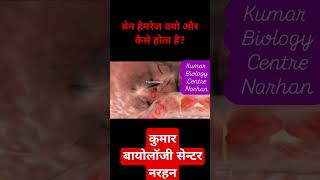 How brain hemorrhage occursviralvideo sujit kumar [upl. by Lunn660]