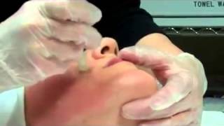 Dermapen Micro Needling Treatment [upl. by Aliekahs]