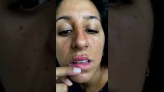 Cystic acne and blackheads removal  Newest pimple pops for 2022 [upl. by Aham571]