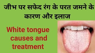 जीभ पर सफेद रंग की परत जमने के इलाज White tongue treatmentजीभ सफेद होने के कारण [upl. by Elysha478]