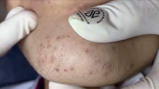 Acne On Girls Chin  Acne Treatment Nhat Bang [upl. by Brick]