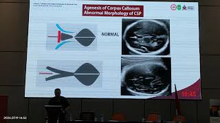 Video 2 Corpus Callosum Diagnosis [upl. by Assilram]