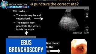 EBUS Bronchoscopy Curiosities [upl. by Ilbert]