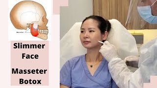 Botox Injections to Masseter Muscles How to get slimmer face [upl. by Martelli]