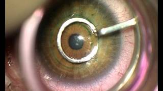 Implantation of Intrastromal Corneal Ring Segments [upl. by Hartwell]