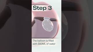 Allurion Gastric Balloon  A Simple Solution to Lasting Weight Loss [upl. by Hairu]