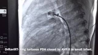 DrRaviRT  Long tortuous PDA closed using AVP II [upl. by Ellehsyt]