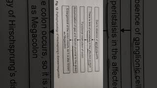 Pathophysiology of Megacolonhirschsprungs diseassy [upl. by Bertero]