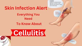 Cellulitis [upl. by Hussey]