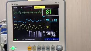 Pacemaker patient  under observation of two multipara patient monitor  mindray  yonker ECGSPO2 [upl. by Studner]