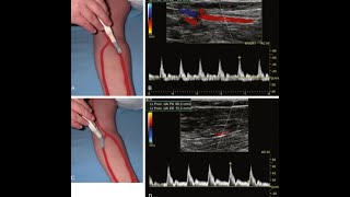 Upper Limb Arterial Doppler  How to do د عمرو صلاح [upl. by Rodolfo]