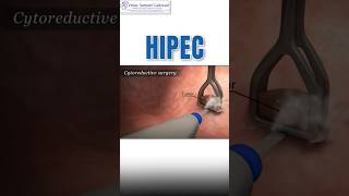 What is HIPEC  Cancer treatment cancertreatment hipec [upl. by Iral]