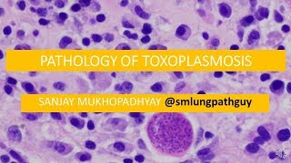 Pathology of toxoplasmosis [upl. by Cornela]