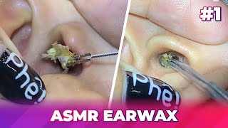 1 Earwax ASMR  Surprised by the dirty ear and how to clean it [upl. by Bedell]