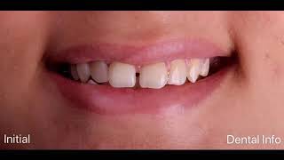 Direct Diastema Closure [upl. by Tila]